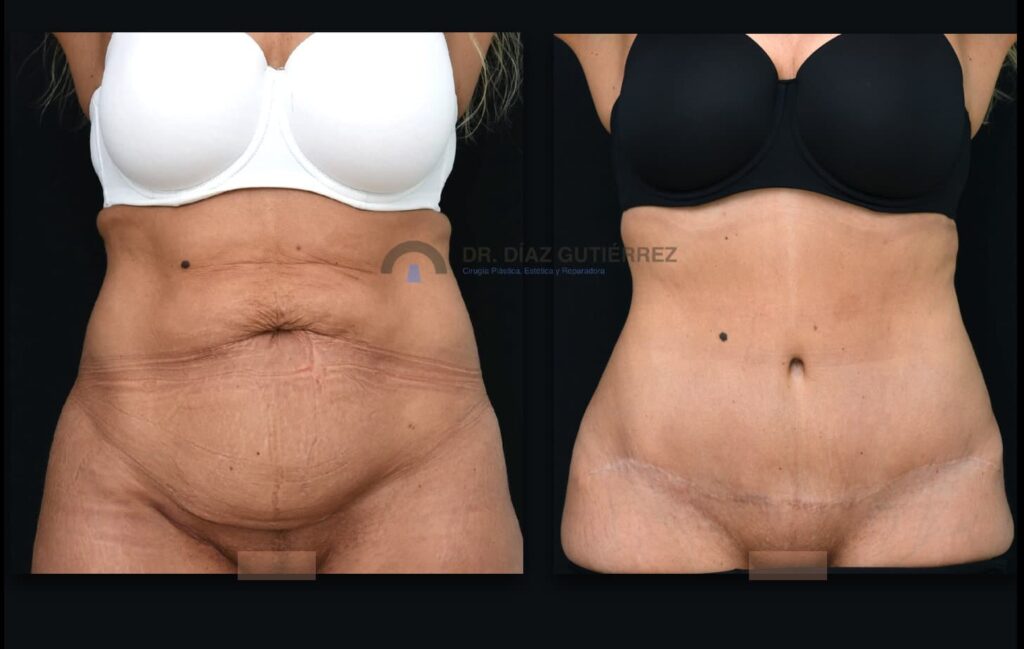 Resultados de antes y después mostrando la diferencia entre liposucción y abdominoplastia.