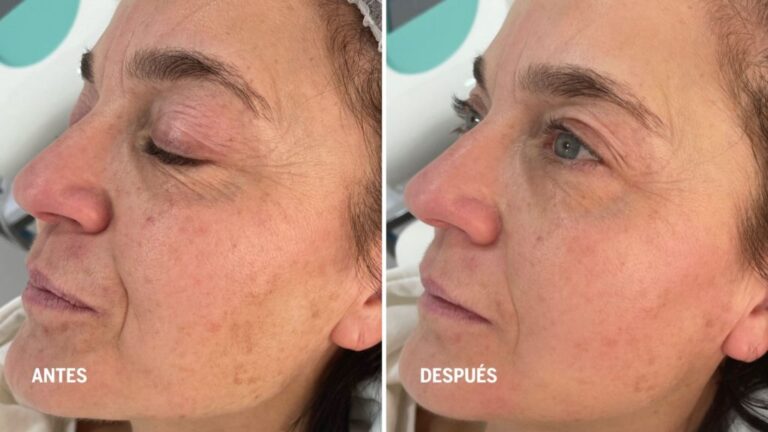 Rejuvenecimiento Facial Sin Cirugía