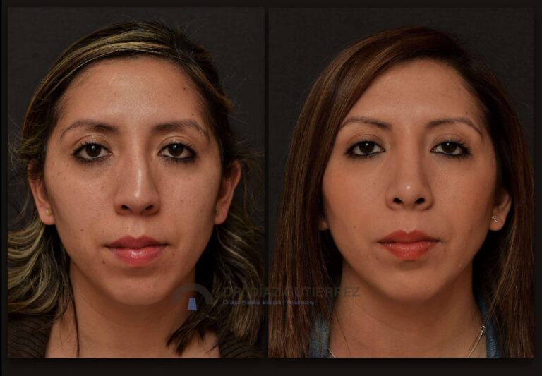 Perfil de rostro mostrando la nariz antes de conocer los tipos de rinoplastia.