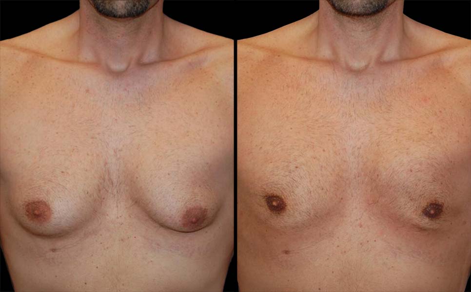 Torso masculino bien definido después de una cirugía de ginecomastia