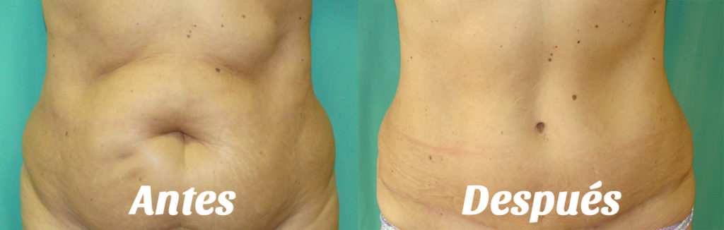 Diagrama comparativo de la zona tratada en una liposucción vs. abdominoplastia